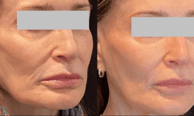 zabieg-kwasem-polimlekowym