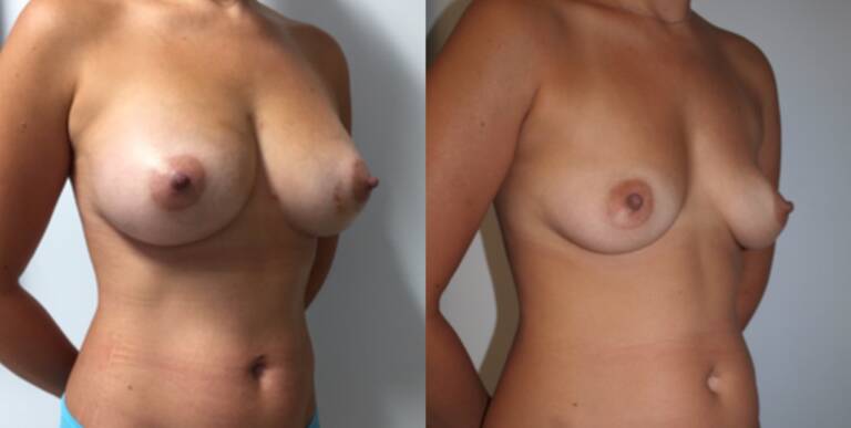 Powiększanie-piersi-własnym-tłuszczem-wrocław-4