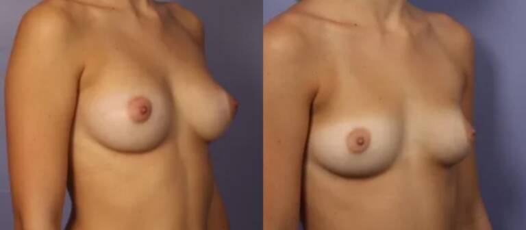 Powiększanie-piersi-własnym-tłuszczem-wrocław-5