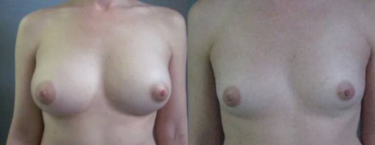 Powiększanie-piersi-własnym-tłuszczem-wrocław-6