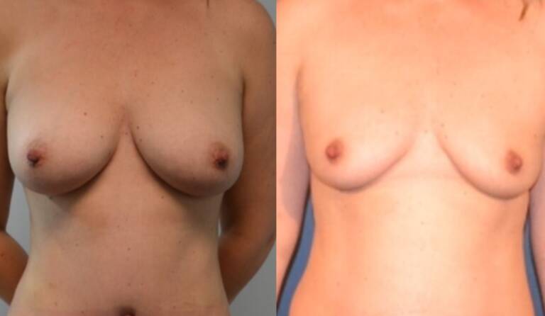 Powiększanie-piersi-własnym-tłuszczem-wrocław