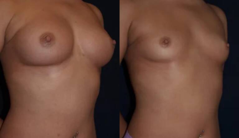 Powiększanie-piersi-wrocław-2