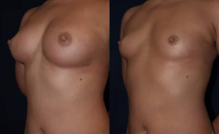 Powiększanie-piersi-wrocław-3