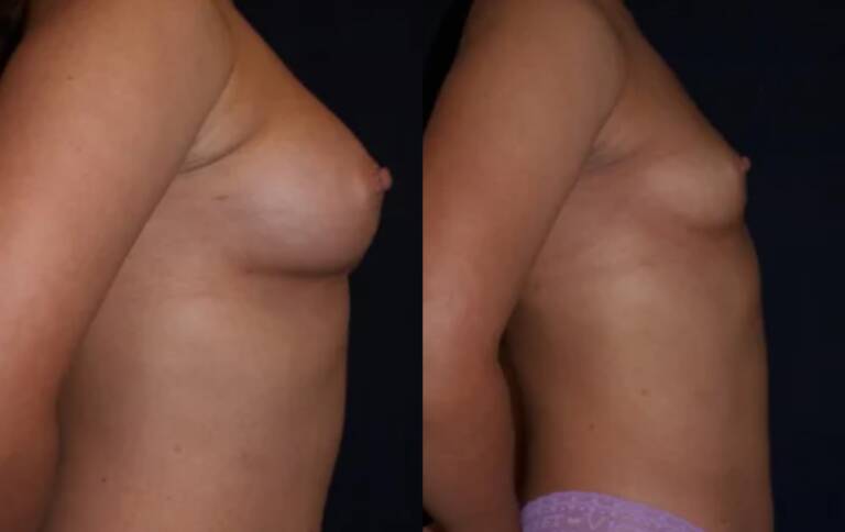 Powiększanie-piersi-wrocław-4