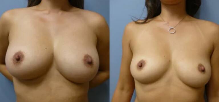 Powiększanie-piersi-wrocław-5