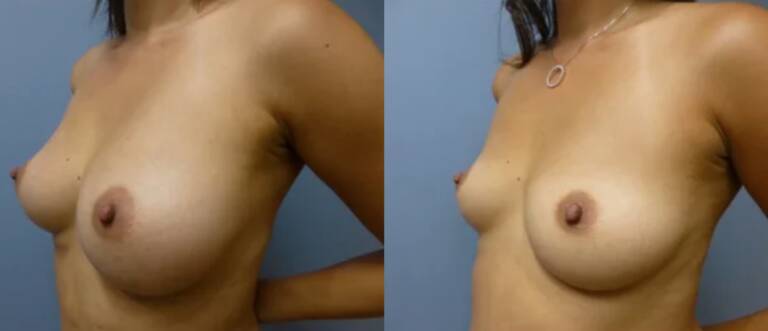 Powiększanie-piersi-wrocław-6