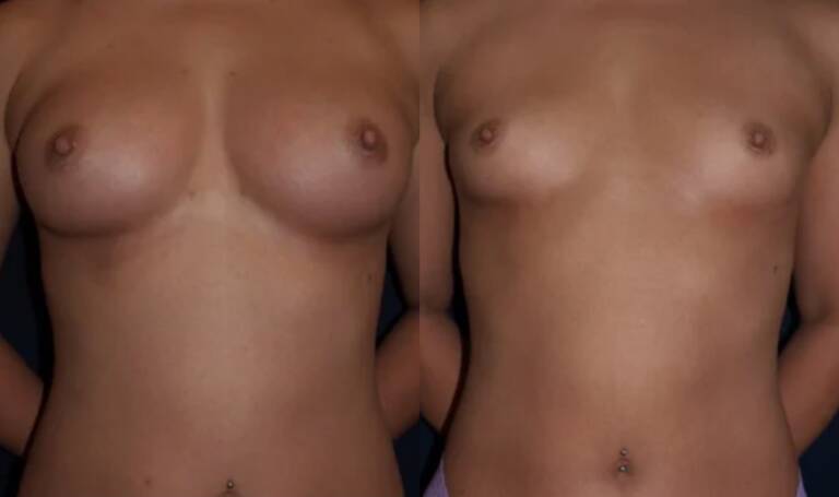 Powiększanie-piersi-wrocław