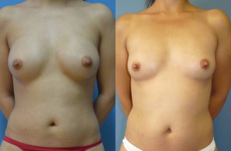 Powiększanie-piersi-wrocław-własnym-tłuszczem-efekty-2