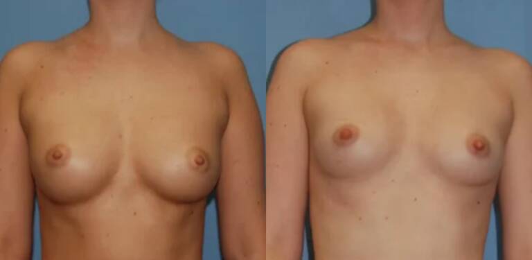 Powiększanie-piersi-wrocław-własnym-tłuszczem-efekty-6