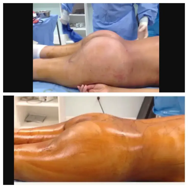 bbl-brazylijski-lifting-pośladków-11-wrocław