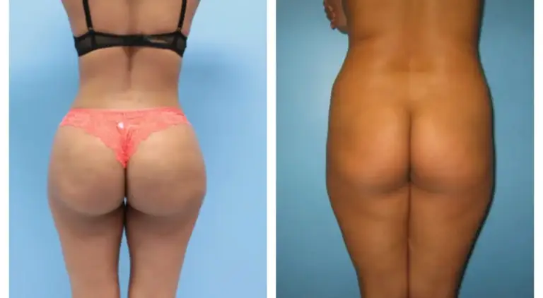 bbl-brazylijski-lifting-pośladków-12-wrocław