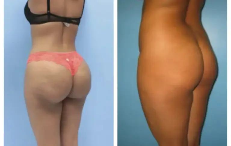 bbl-brazylijski-lifting-pośladków-13-wrocław