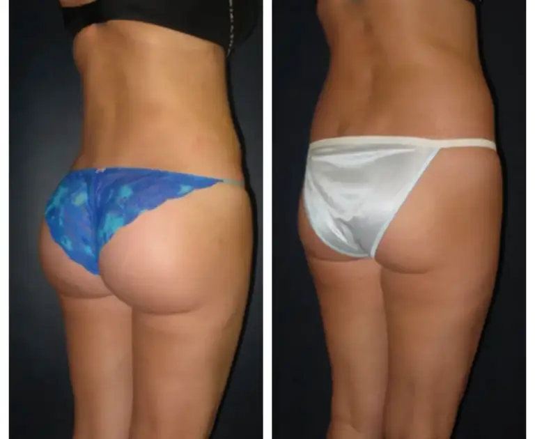 bbl-brazylijski-lifting-pośladków-3