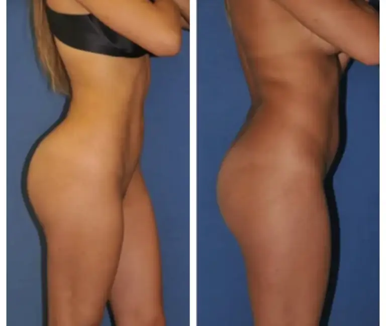 bbl-brazylijski-lifting-pośladków-4