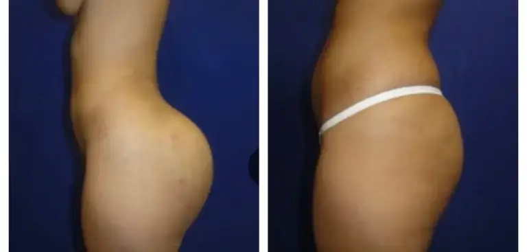 bbl-brazylijski-lifting-pośladków-6