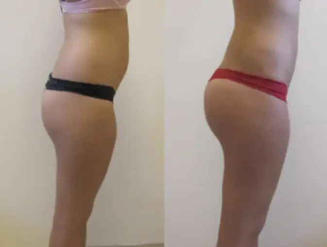 bbl-brazylijski-lifting-pośladków-9