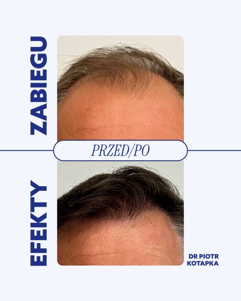 opinie-piotr-kotapka-przeszczep-włosów-wrocław