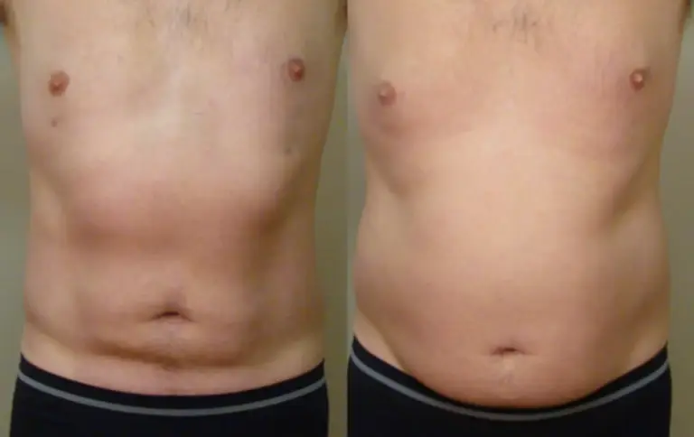 liposukcja-brzucha-tesoro-wrocław-2