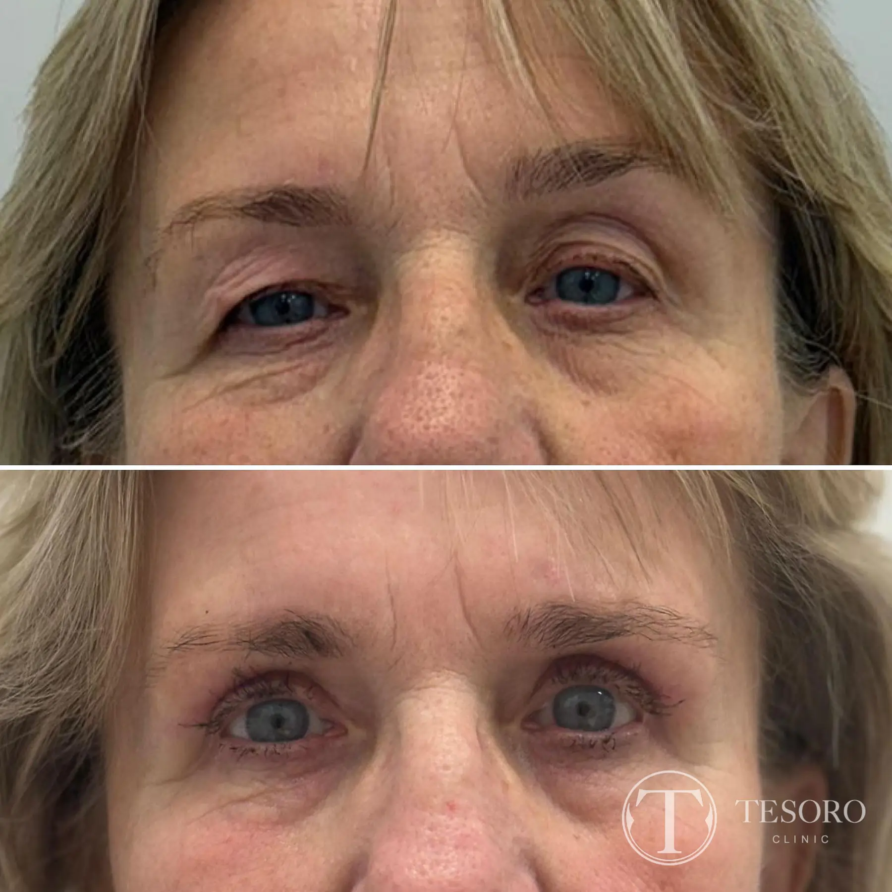plastyka powiek wrocław Tesoro Clinic 37