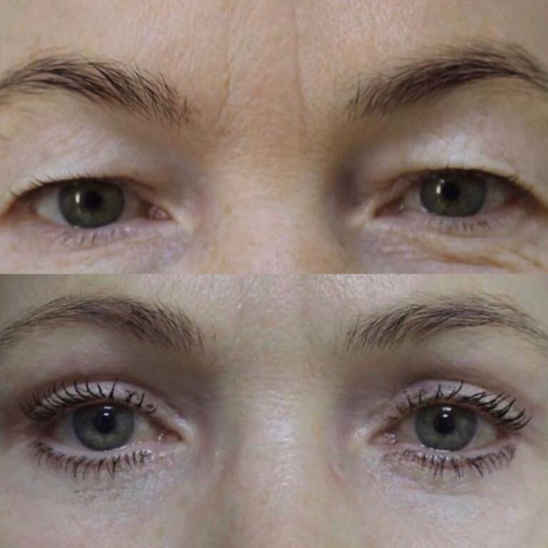 chirurgiczna korekcja powiek