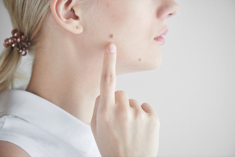 Usuwanie pieprzyków