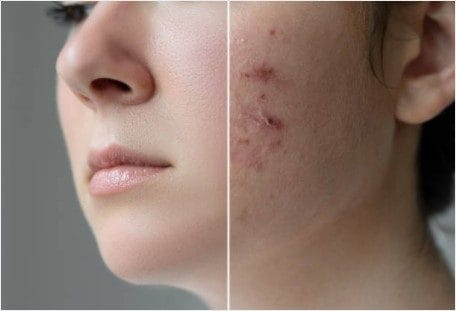 jak usunąć blizny potrądzikowe