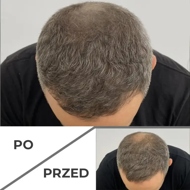 Mikropigmentacja skóry głowy wrocław 2