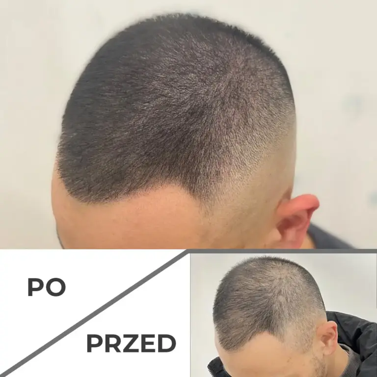 Mikropigmentacja skóry głowy wrocław 3