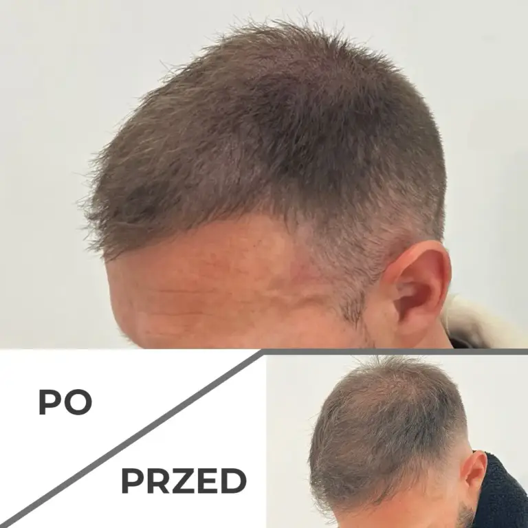 Mikropigmentacja skóry głowy wrocław 4