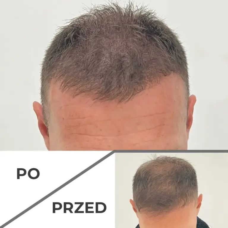 Mikropigmentacja skóry głowy wrocław 5