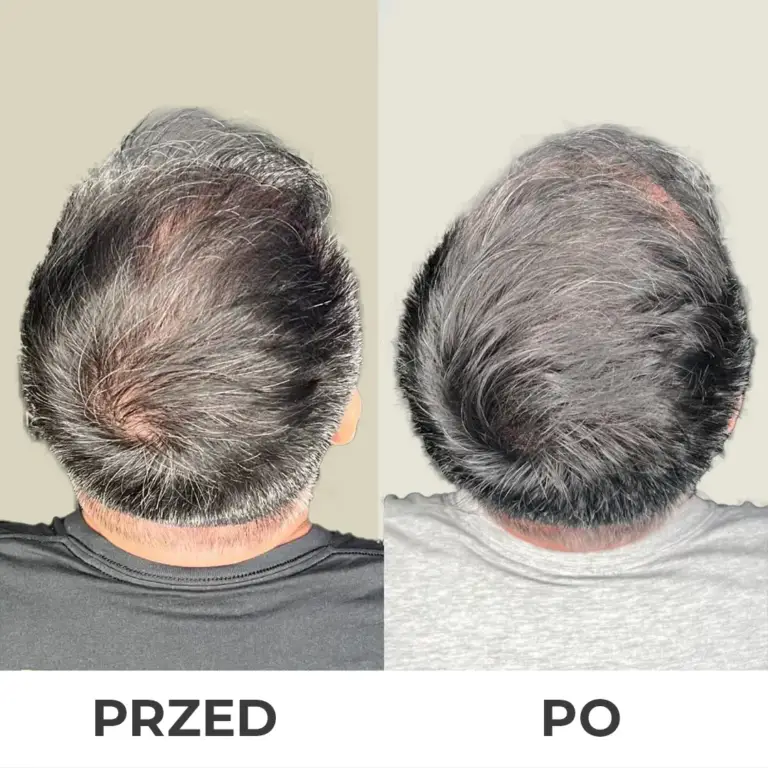 Mikropigmentacja skóry głowy wrocław 7